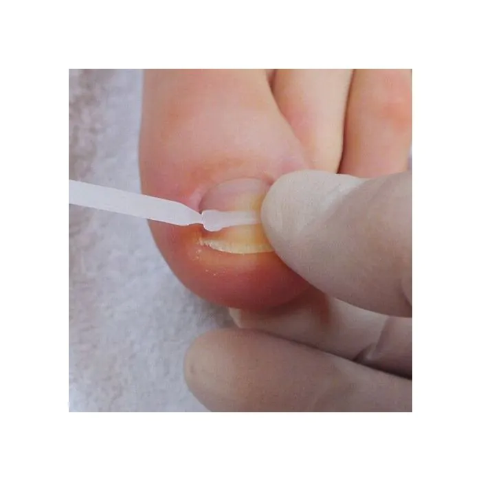 Podostripe Nagelbeugels - 8 stuks