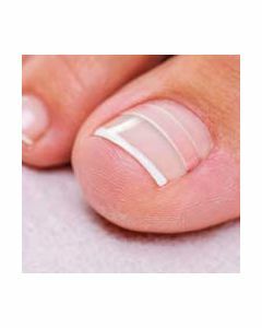 Medisch Pedicure:  Nagelbeugels 